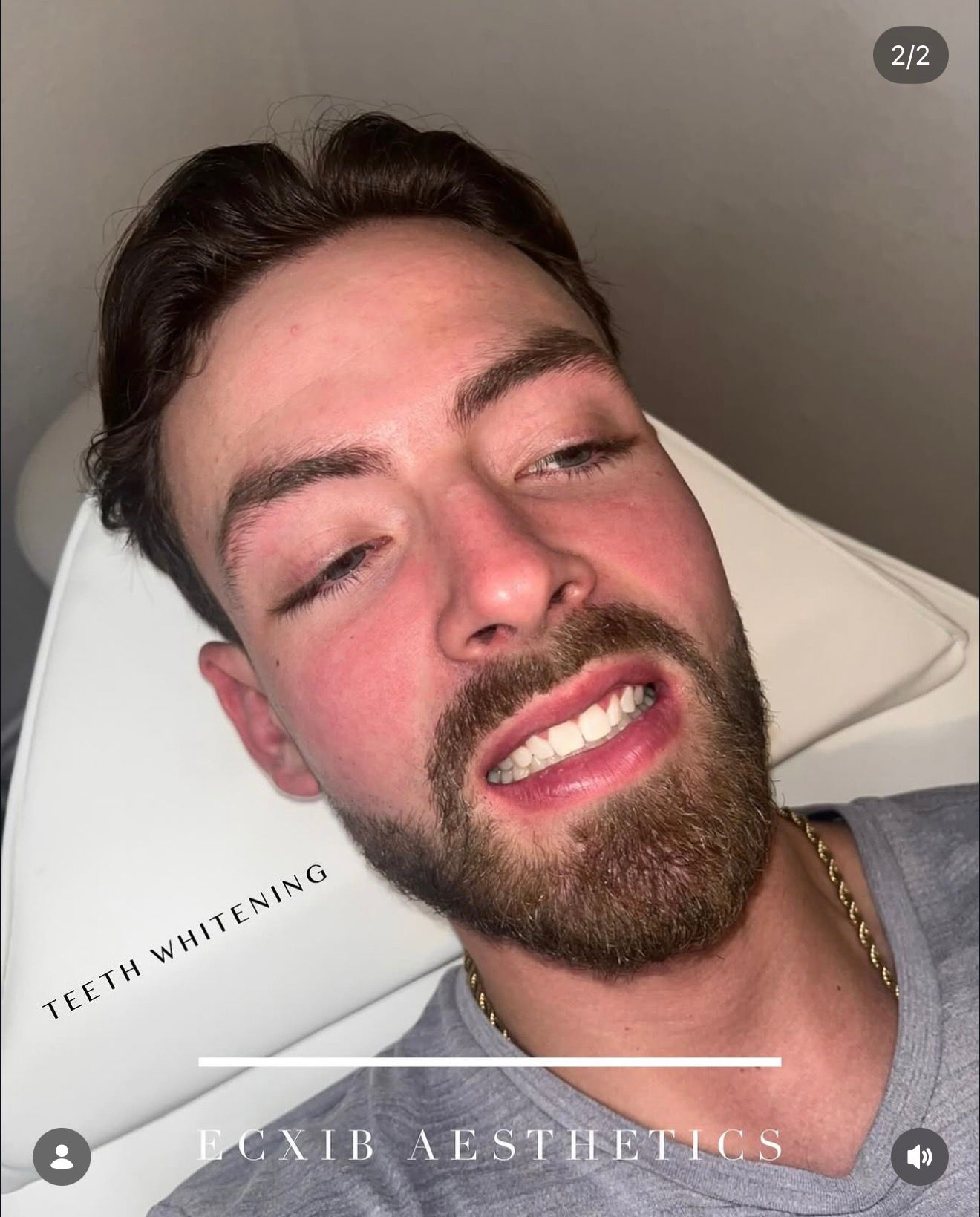 Female client teeth whitening before and after result — ECXIB Aesthetics Kent