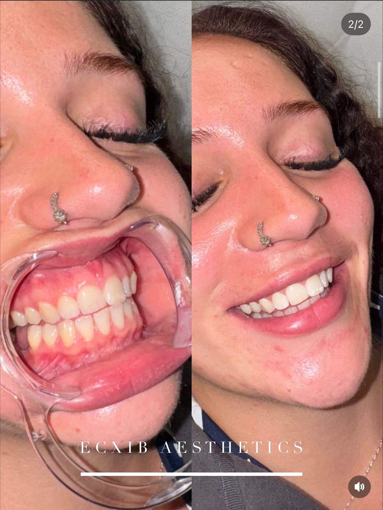 Teeth whitening before and after result — ECXIB Aesthetics Chatham Kent