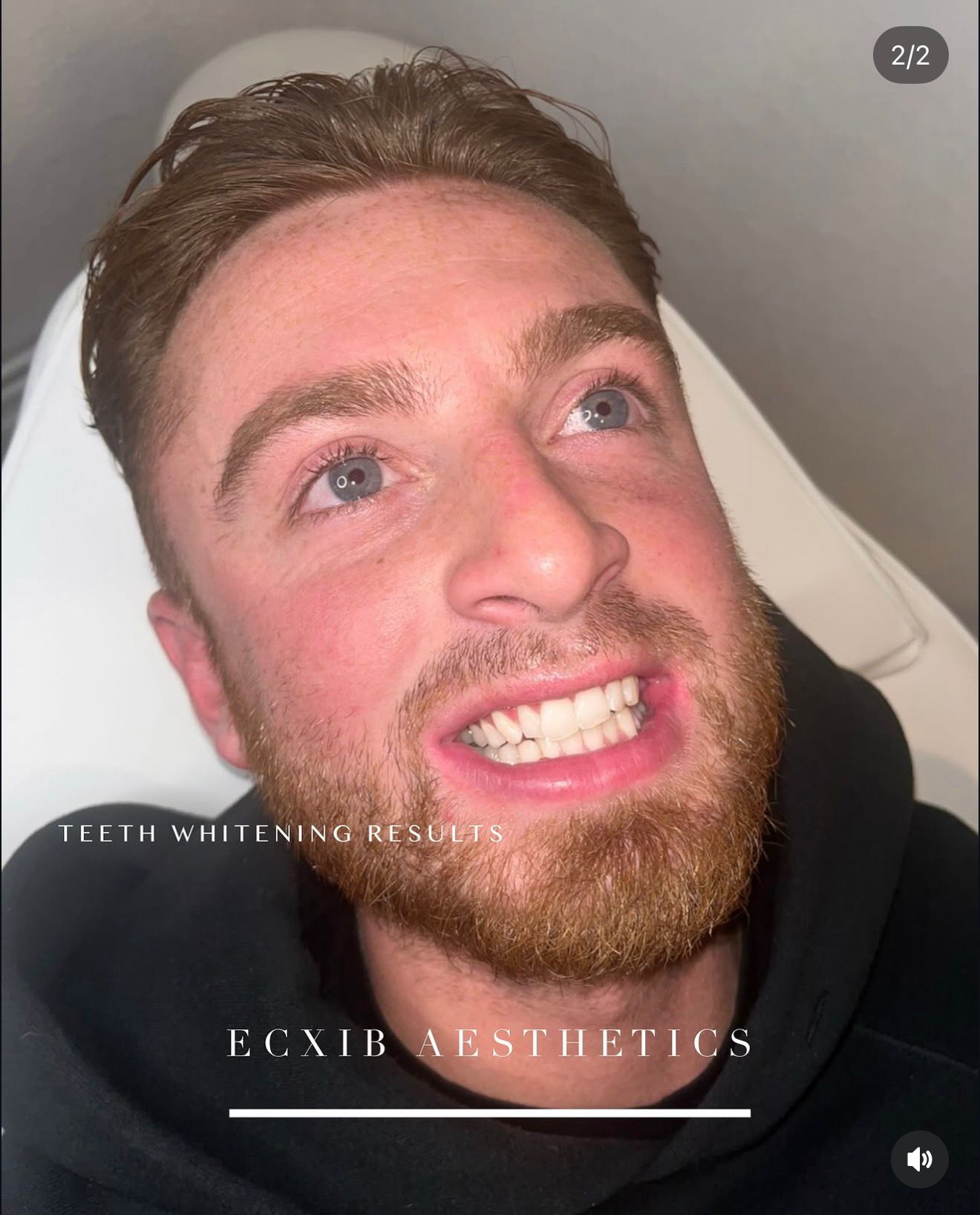 Male client teeth whitening before and after result — Chatham Kent