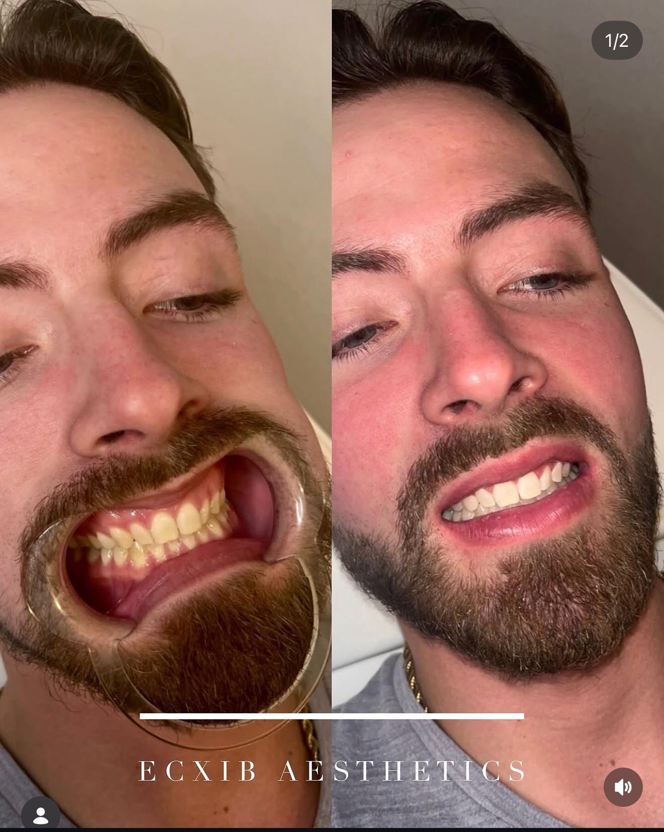 Male client teeth whitening result before and after — ECXIB Aesthetics